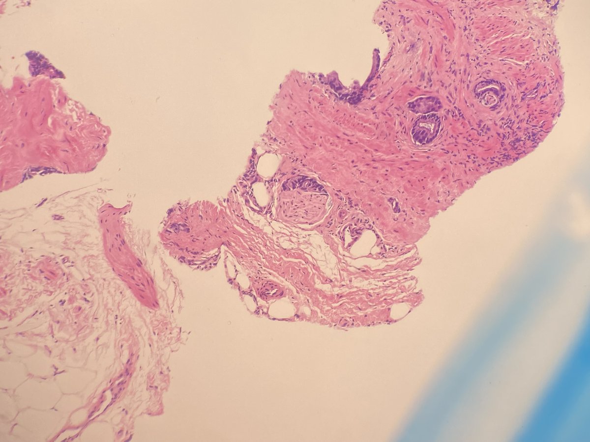 slusagar's tweet photo. #grayzonepath #GUpath prostate bx:
(no "right" answer, but good depiction & case for discussion)
📸🔬 here
⏬
poll to follow https://t.co/F3ZyL8wM38