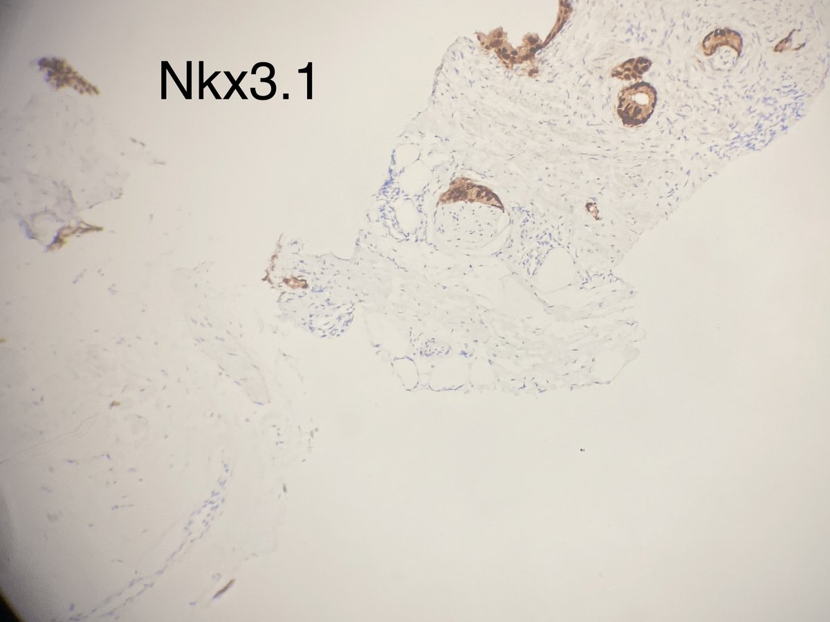 slusagar's tweet photo. #grayzonepath #GUpath prostate bx:
(no "right" answer, but good depiction & case for discussion)
📸🔬 here
⏬
poll to follow https://t.co/F3ZyL8wM38