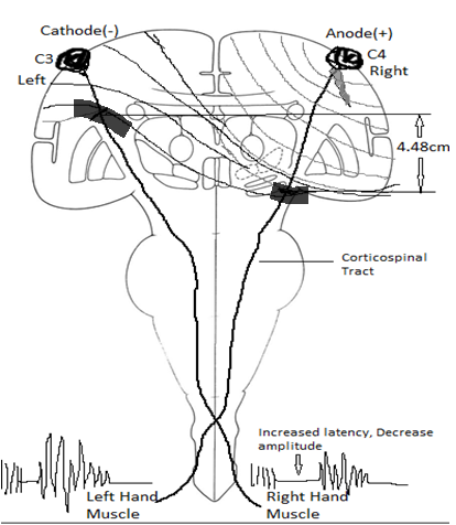 JClinNeurophys's tweet image. Gonzalez et al. analyze the latency and amplitude of transcranial motor evoked potentials responses from the #contralateral and #ipsilateral muscle groups to the same stimulus in our new study! bit.ly/37CQakf @UCRiverside @NeurosurgeryUSC @ACNS_org #ClinNeurophys