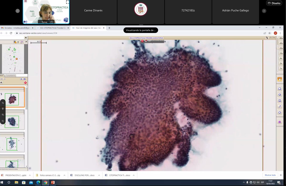 Día de #citopractica con la Dra. Bella enseñándonos #PAAF de #Tiroides 
Casos muy docentes para repasar el sistema #Bethesda 🤓
#CitopatCat #Cytopath #NIFTP #Hürthle #Papilar
