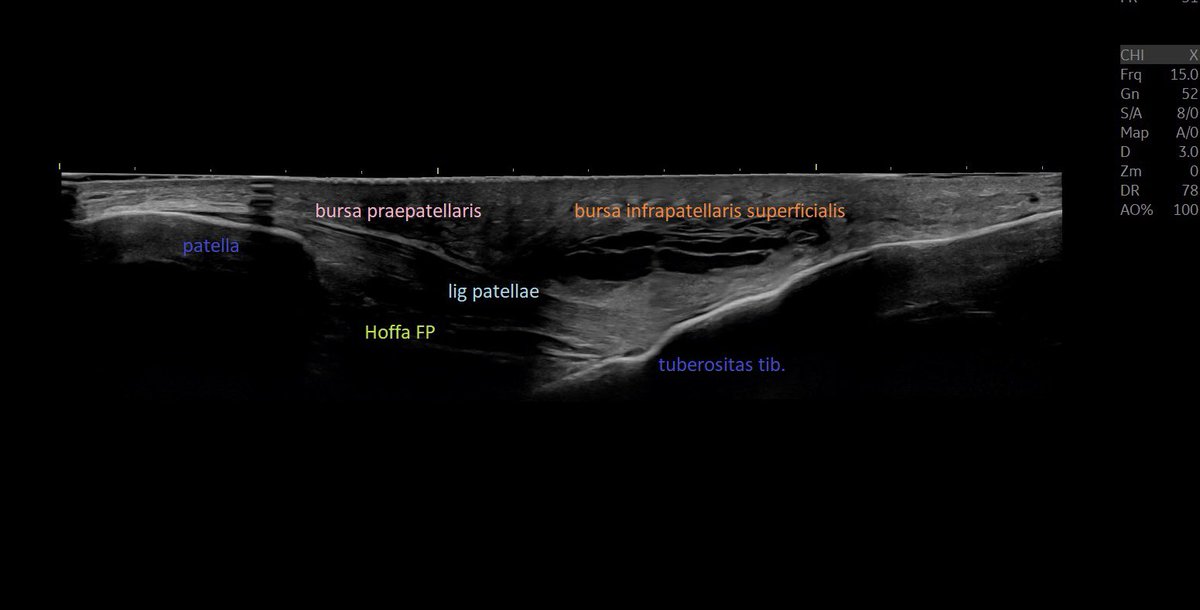SportklinikBern's tweet photo. Infrapatellar pain and swelling for month after direct trauma of the knee —> post traumatic hematoma with bursitis infrapatellaris superficialis #mskus #pocus #pocushub #logiqE10 https://t.co/lQSWvx7qhO