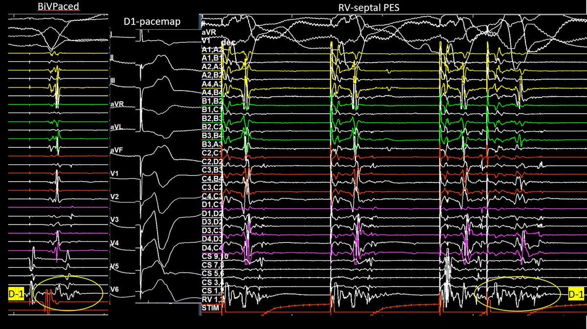 EhdaieMd's tweet photo. How deep is your DEEP?

Septal venous mapping 2 distinct VTs from LV summit w/absurd EGM decrement (NICM)

Term endo/non-inducible

Do we celebrate w/ 10cc venous alcohol or abstain? @MiguelVldrbno #AblateVT #EGMsFirst https://t.co/grNusR4k2l