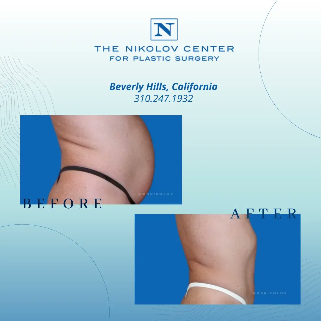 DrNikolov's tweet photo. Be #summer-ready and bikini-ready - now. 

Give us a call for an appointment and consultation. Online consultation is also available. 

#cosmeticsurgery #plasticsurgery #tummytucksurgery #tummytuck https://t.co/kHTApeUuQi