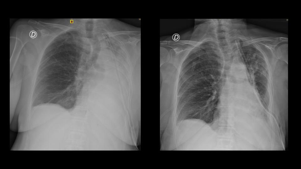 NicoOnTheRoad's tweet photo. Cuando la #fisioterapiarespiratoria justifica su presencia resuelve una atelectasia, disminuye el riesgo de sobreinfección y evita una fibrobroncoscopía para desobstruir. #CuSuFiRe @kinerespihiba https://t.co/LhqnHzr2Wc