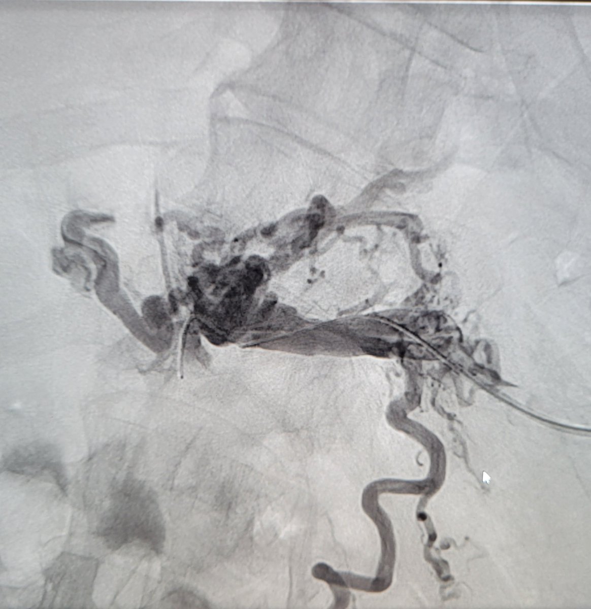 TempleRADs's tweet photo. Patient with portal vein thrombosis and GI bleed. Recannulized portal vein via transplenic access. TIPS performed with transhepatic gunsight technique. Amazing result at the end with resolution of symptoms! @spratipat Raj Patel. @TempleRadRes @SIR_ECS @SIRRFS #IRAD https://t.co/vONR3Pb7lp