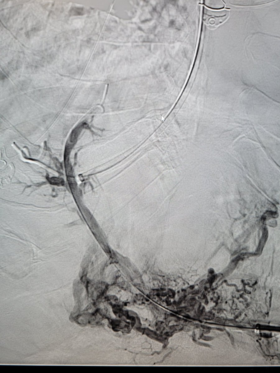 TempleRADs's tweet photo. Patient with portal vein thrombosis and GI bleed. Recannulized portal vein via transplenic access. TIPS performed with transhepatic gunsight technique. Amazing result at the end with resolution of symptoms! @spratipat Raj Patel. @TempleRadRes @SIR_ECS @SIRRFS #IRAD https://t.co/vONR3Pb7lp