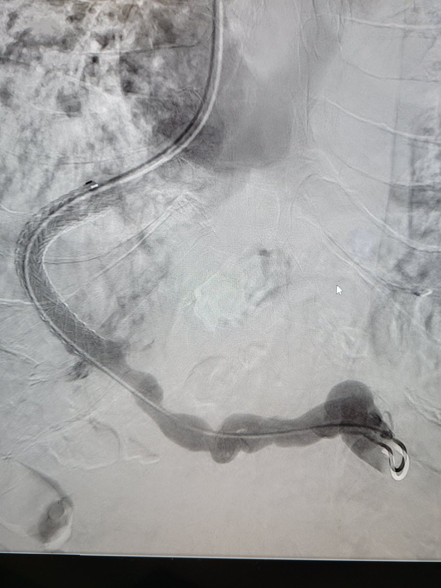TempleRADs's tweet photo. Patient with portal vein thrombosis and GI bleed. Recannulized portal vein via transplenic access. TIPS performed with transhepatic gunsight technique. Amazing result at the end with resolution of symptoms! @spratipat Raj Patel. @TempleRadRes @SIR_ECS @SIRRFS #IRAD https://t.co/vONR3Pb7lp