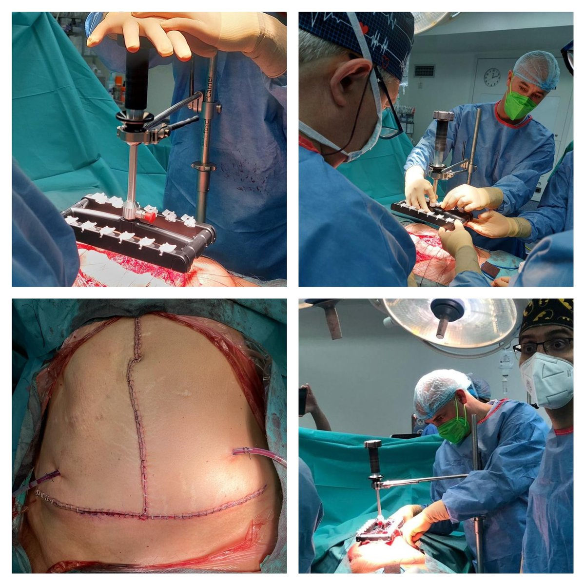 DrGutch's tweet photo. Finally first Fasciotens in Mérida, open surgery in a woman with 15 cms of defect M1-4W3. Botox. We could avoid TAR,complete close. Always innovating Thanks to Dr Gereon Lill. @aecirujanos @AecPared @SalidoSergio @jbellidoluque @smoralesconde @alopezfarias @DrGutch https://t.co/WuP4rg7lhL