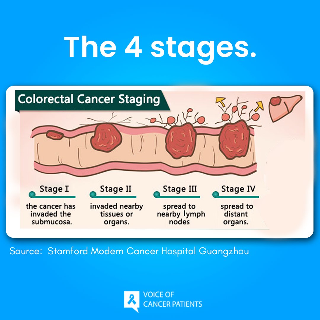 Colon Cancer Stage 4