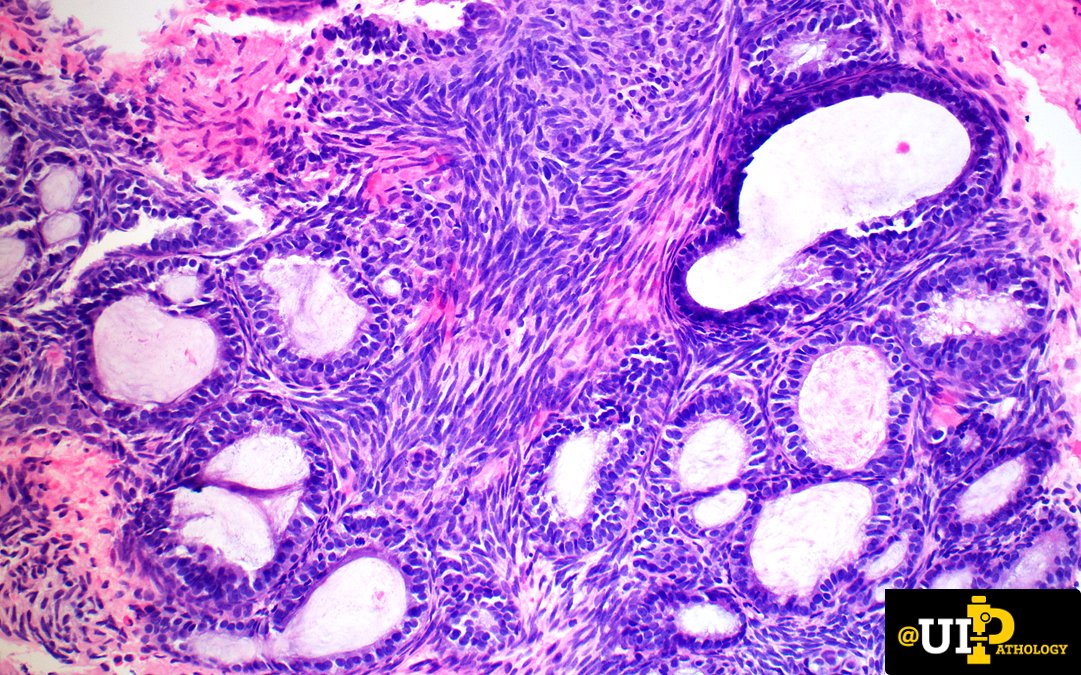 UIPathology's tweet photo. Thigh mass in a young adult. What is the most likely IHC profile? #bstpath #IowaPath
A) TLE1 patchy+, H3K27me3 ret, CD34+, STAT6+
B) TLE1 patchy+, H3K27me3 lost, CD34-, STAT6-
C) TLE1 -, H3K27me3 ret, CD34+, CK-
D) TLE1 diffuse+, H3K27me3 ret, CD34-, CK+
📸:@AlexIsaacsonMD https://t.co/lLSzTuv98v