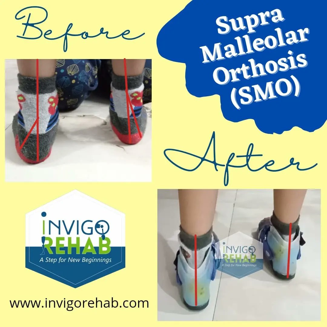 #invigorehab #orthotics #Pediatrics #smo #supramalleolarorthosis #footorthotics #orthopedicsurgery #surgtwitter #MedTwitter #orthopedics #PatientCare