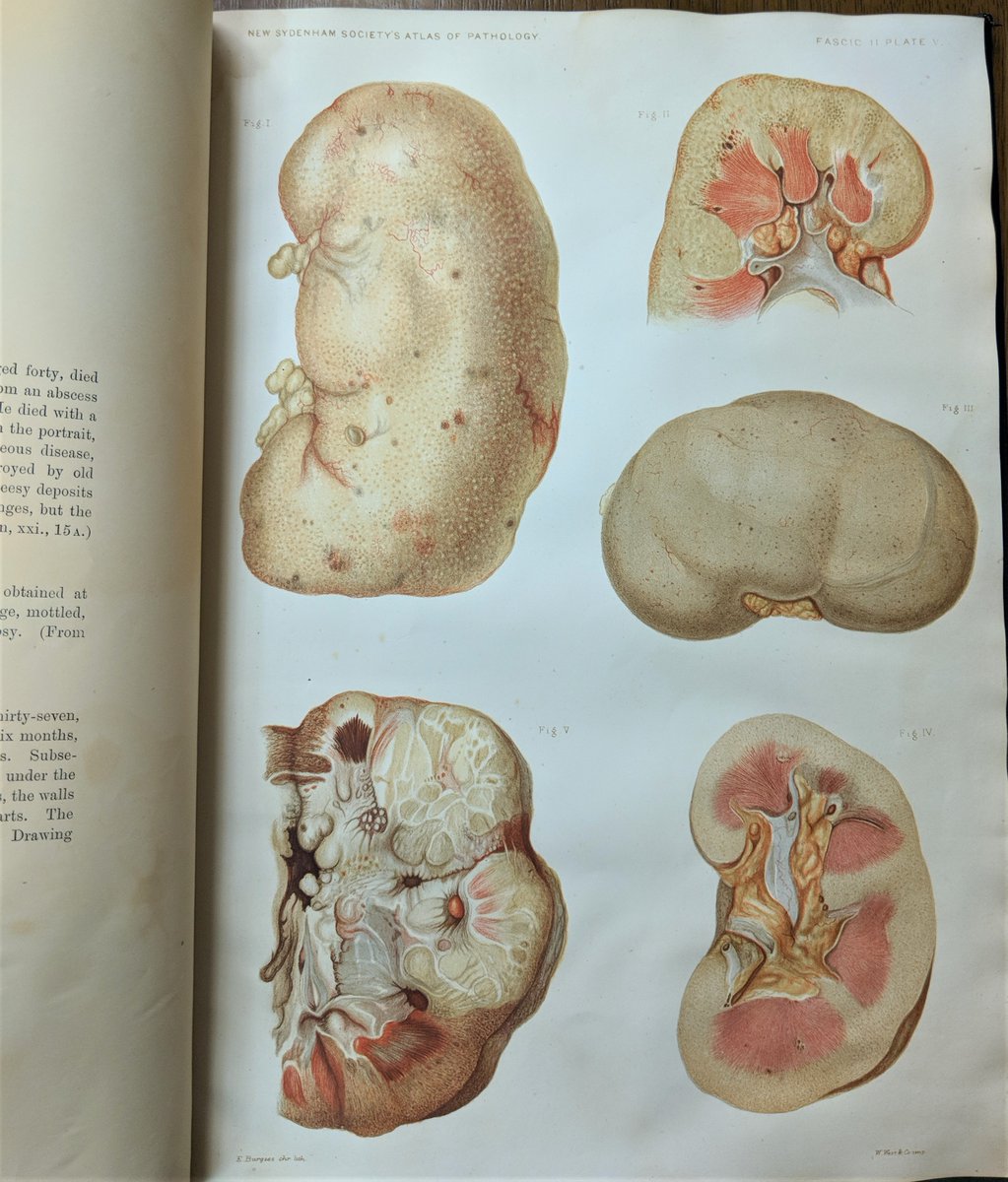 Diseased kidneys by E. Burgess. Chromolithograph, 1877/1899?. 
#scientificillustration #sciart #anatomyart #anatomy