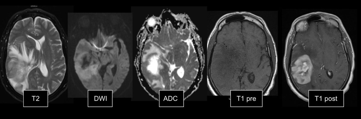 1/ 🧵Pt p/w headaches and 2 weeks of progressive left sided weakness. No history of immunosuppression. Open image of selected MRI brain w/ and w/o sequences ⬇️

#Medtwitter #neurotwitter #onctwitter #foam #foamncc #neurology #neuroonc