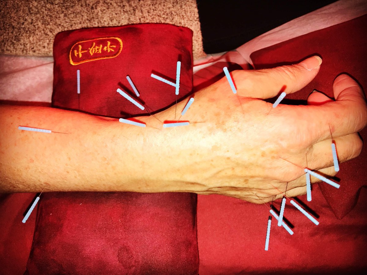 ChasAcupuncture's tweet photo. This is a typical  treatment for arthritis in the hands caused by old age, years of manual labor or repetitive activities. Charleston Acupuncture is accepting new patients. To schedule your appointment with Treayor Smith call 843-806-9402. #arthritisacupuncture  #TCM https://t.co/qYkSYp23X0
