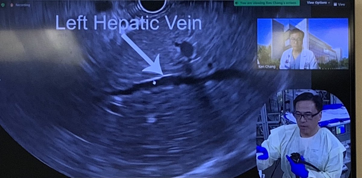 Great lecture by Dr. Kenneth Chang on #endohepatology &amp; #EUS guided portal pressure measurements

Presented a case of EUS guided HVPG measurements for use in the diagnosis of pre-sinusoidal portal HTN

Curious when others reach for EUS portal pressure measurements🤔
#LiverTwitter