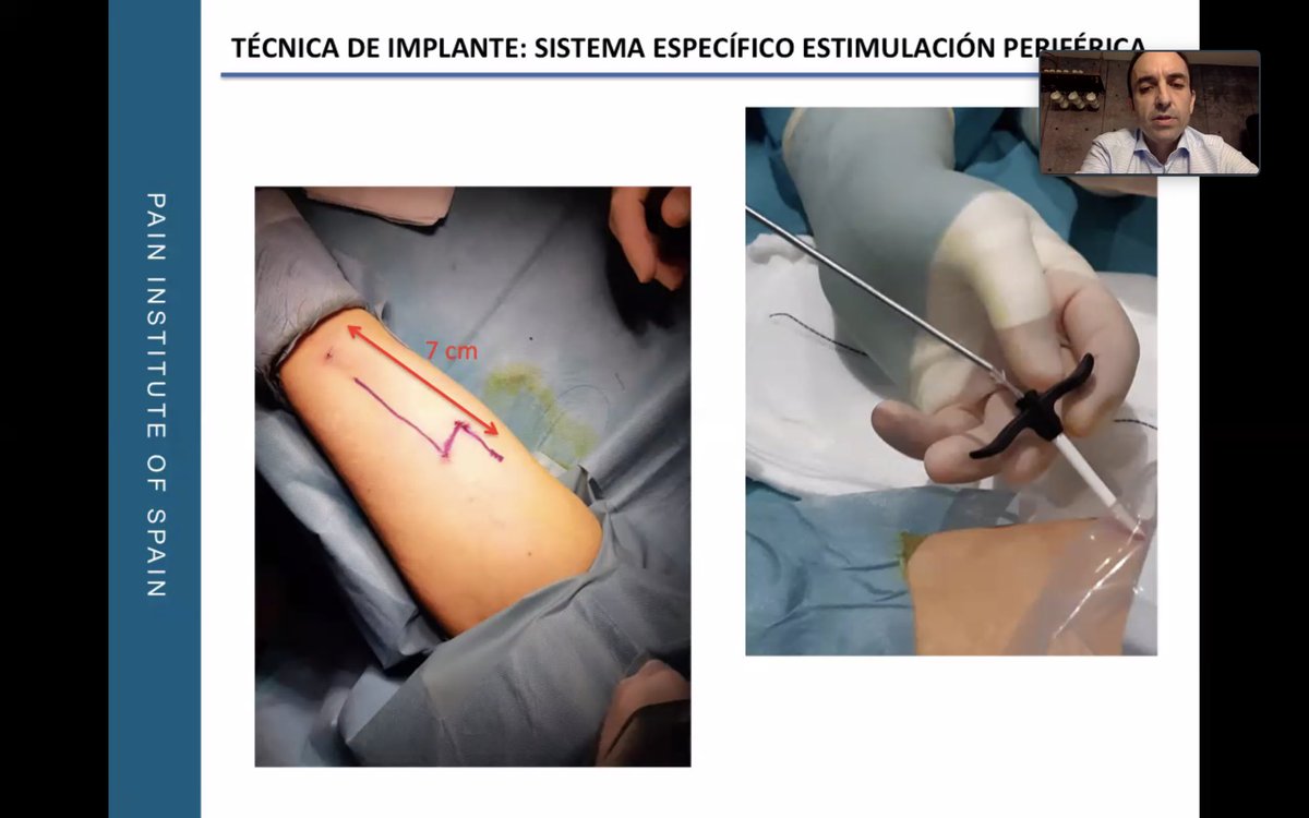 pios_institute's tweet photo. Curso interesantísimo y muy util sobre #neuroestimulacion #periferica para #dolor #neuropatico . Gracias a Jesús de Santiago y Rogelio Rosado por su participación y a @primneuromod por su colaboración #stimrouter #pios https://t.co/YxRxT4PcRi