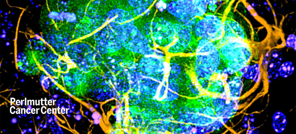 ACS_Research's tweet photo. With funding from an @AmericanCancer-@MelanomaReAlli partnership, Dr. Eva Hernando of @nyulangone led a study now out in @CD_AACR that revealed a new connection between melanoma brain metastasis and neurodegeneration:

https://t.co/q0O8fsupgj https://t.co/oe4Snni9kg