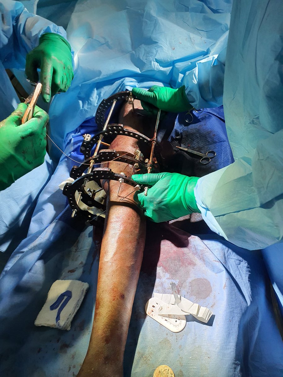 DrKebsun's tweet photo. Day 5 today. So far 21 cases done in total. Great results with life changing potential for some. Amazing teamwork and collaboration. Another great trip..3 theatres tomorrow and mop on Friday. #LastLeg #GamMed #EpisodeIV #OrthoTwitter @mamadijarju82 @DijahJarju @BintouTrawally1 https://t.co/G2fIfMlRsw