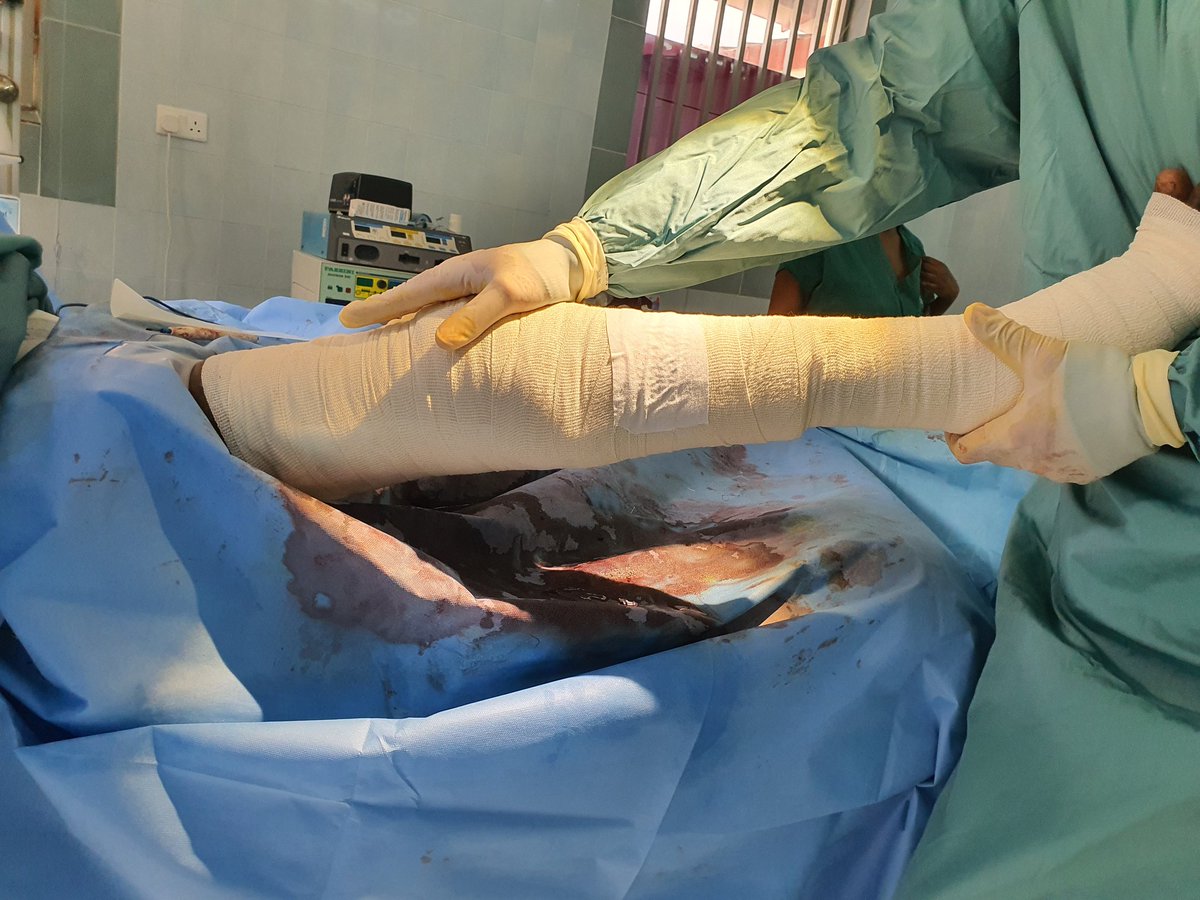 DrKebsun's tweet photo. Day 5 today. So far 21 cases done in total. Great results with life changing potential for some. Amazing teamwork and collaboration. Another great trip..3 theatres tomorrow and mop on Friday. #LastLeg #GamMed #EpisodeIV #OrthoTwitter @mamadijarju82 @DijahJarju @BintouTrawally1 https://t.co/G2fIfMlRsw