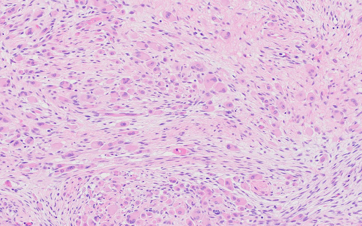 MArnold_PedPath's tweet photo. So here's the rest of the story. This is actually a Wilms tumor. With treatment, skeletal muscle differentiation can become prominent. More common to see this in Europe where pre-surgical chemotherapy is the norm. Excellent detective work by @dinesh_rakheja! #PediPath https://t.co/MnGWNAcU35