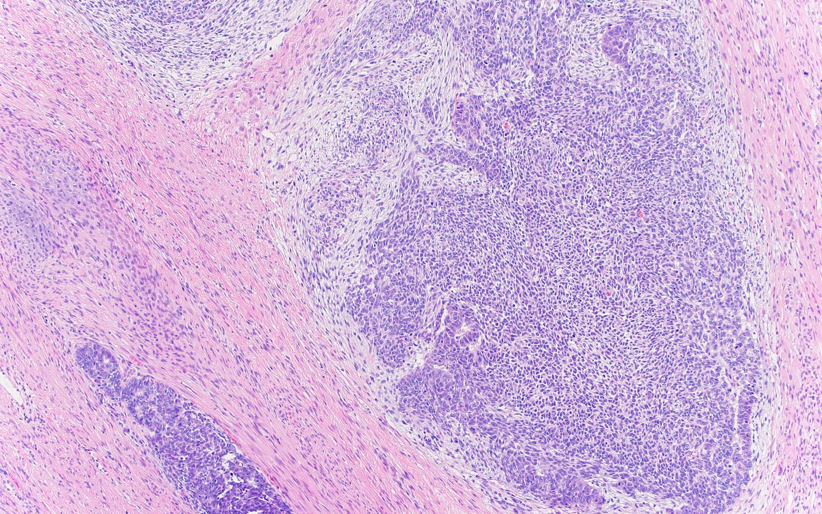 MArnold_PedPath's tweet photo. So here's the rest of the story. This is actually a Wilms tumor. With treatment, skeletal muscle differentiation can become prominent. More common to see this in Europe where pre-surgical chemotherapy is the norm. Excellent detective work by @dinesh_rakheja! #PediPath https://t.co/MnGWNAcU35