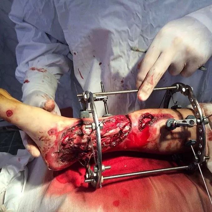 forensicmedic02's tweet photo. Alt ekstremite kırığı durumunda İlizarov cihazı ile osteosentezin intraoperatif görünümü. https://t.co/JANr5Y5z4e