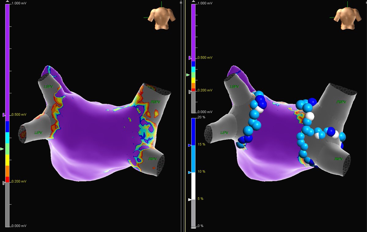 Kaitlin Gallatin (@kaitling_ep) on Twitter photo Great #AbbottAF case on this redo pt. with <a href="/KoerberScott/">Scott Koerber</a>! By utilizing #HDGrid we were able to map both pre and post LA in 16 minutes with over 20,000 points collected. A total ablation time of 32 minutes was taken to re-isolate all 4 PVs!
<a href="/AbbottCardio/">Abbott Cardiovascular</a> #EPeeps Great #AbbottAF case on this redo pt. with <a href="/KoerberScott/">Scott Koerber</a>! By utilizing #HDGrid we were able to map both pre and post LA in 16 minutes with over 20,000 points collected. A total ablation time of 32 minutes was taken to re-isolate all 4 PVs!
<a href="/AbbottCardio/">Abbott Cardiovascular</a> #EPeeps