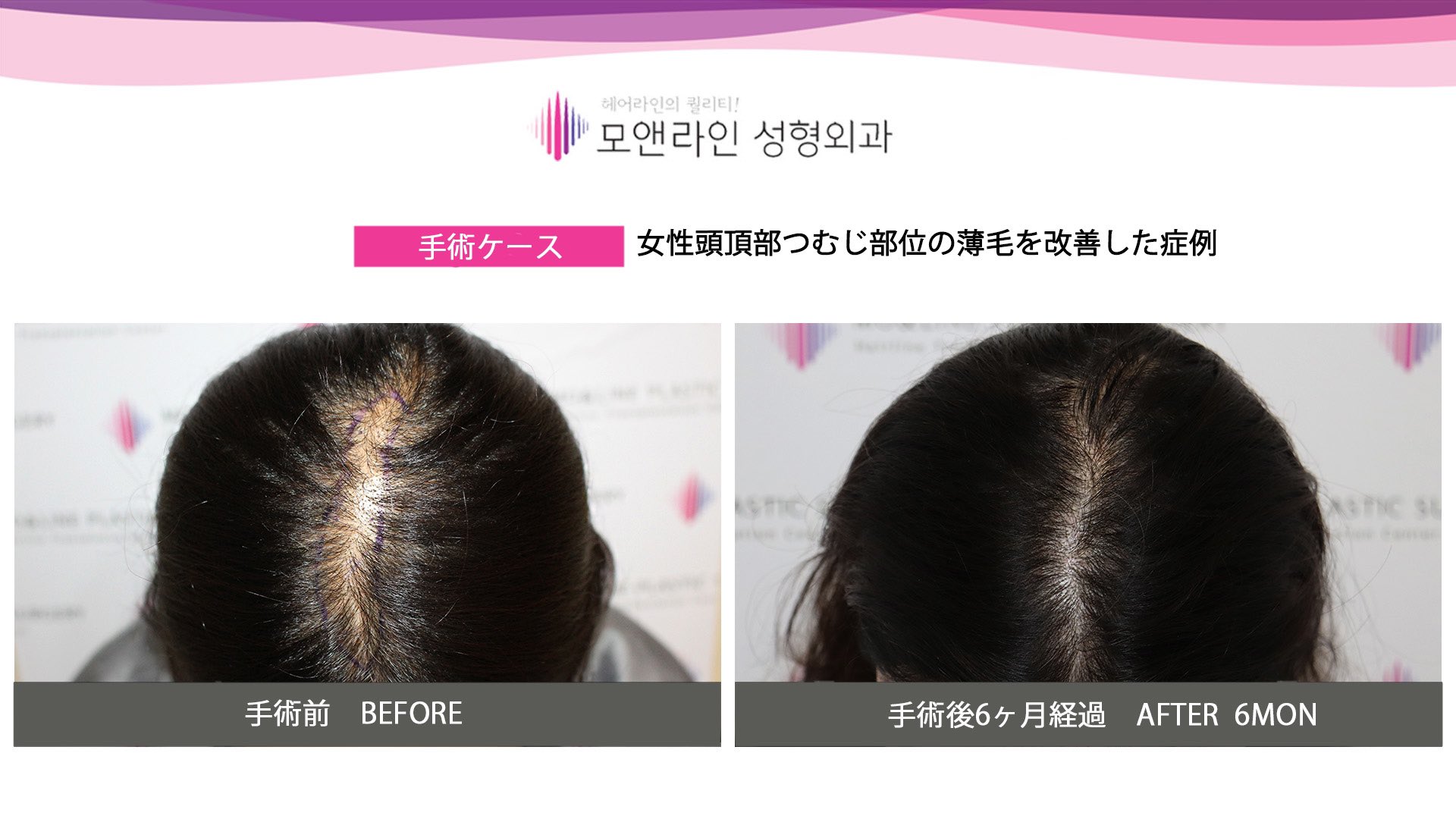 モ ヘアーライン美容整形外科 頭頂部の薄毛の薄毛でお悩みの方少なくないはずです 当院では 毛髪移植手術と並行して非手術薄毛治療を行います 非手術薄毛治療とは 毛髪の成長サイクルを整えて太さと密度を改善させる治療です