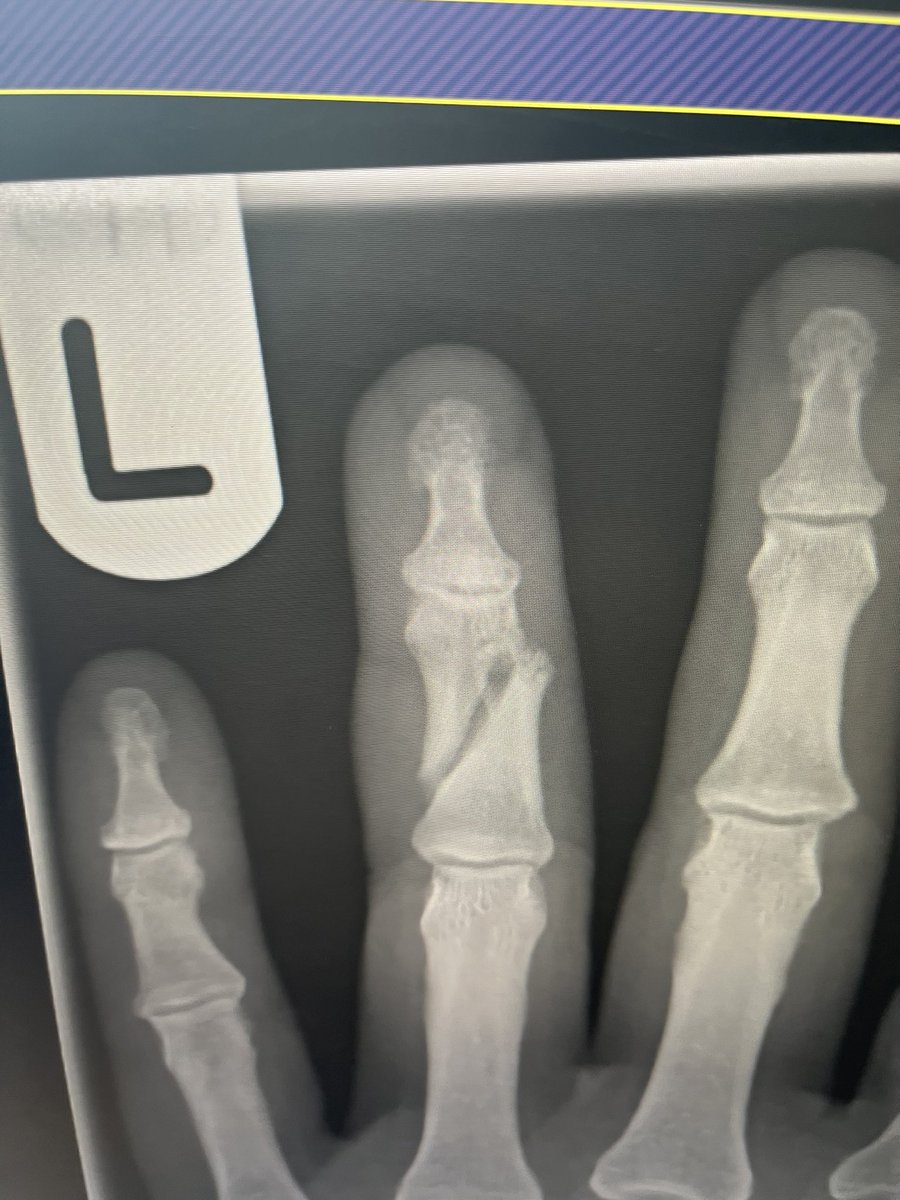 ellieglos's tweet image. Well I suppose I’d better see the trauma surgeon to see just how bad this is 🤦‍♀️😳 #retailstoremanager #tocatchashoplifter