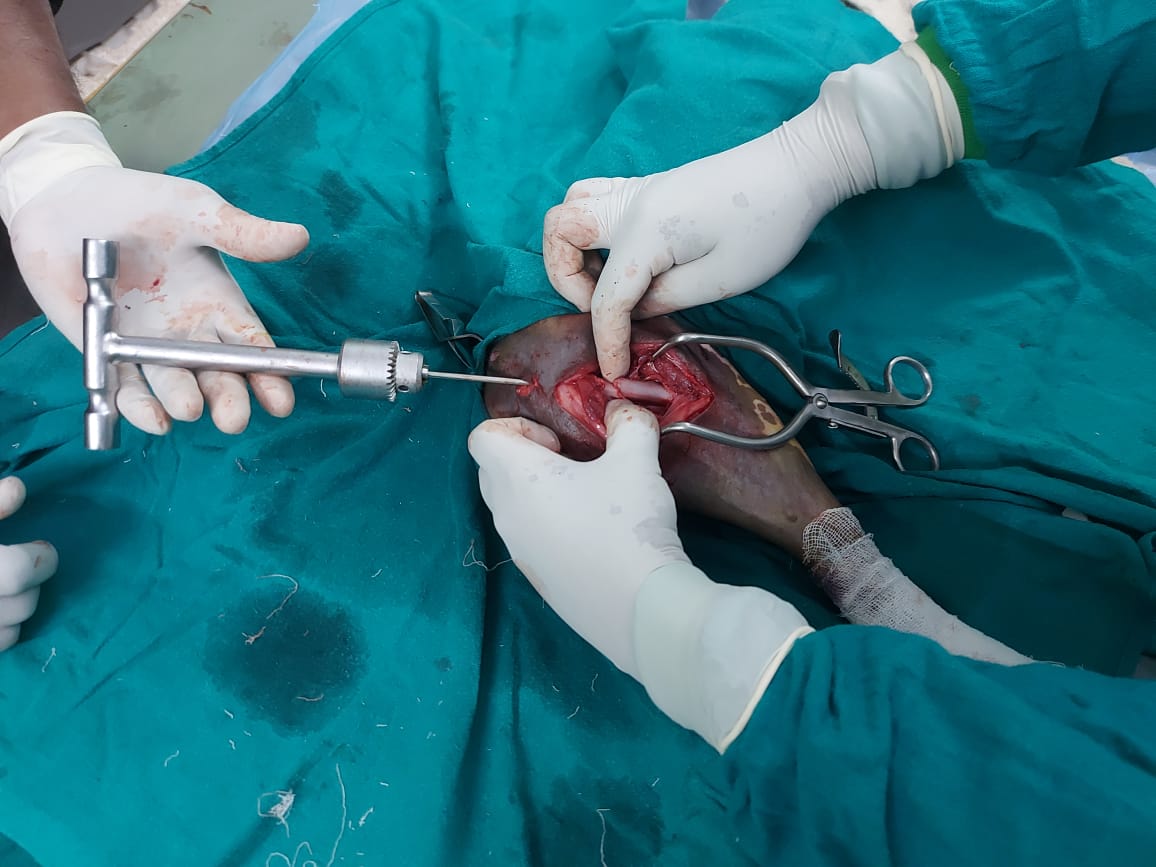 dahvsodisha's tweet photo. Dr Prasant Sika, a vet working at Semiiguda veterinary hospital in Koraput is acting as an ace in veterinary surgery to relieve the pain of dumb animals. A dog with femur fracture critically operated by Dr Sika and intramedullary pinning done using normograde technique.

Kudos! https://t.co/6xex9zQcBm