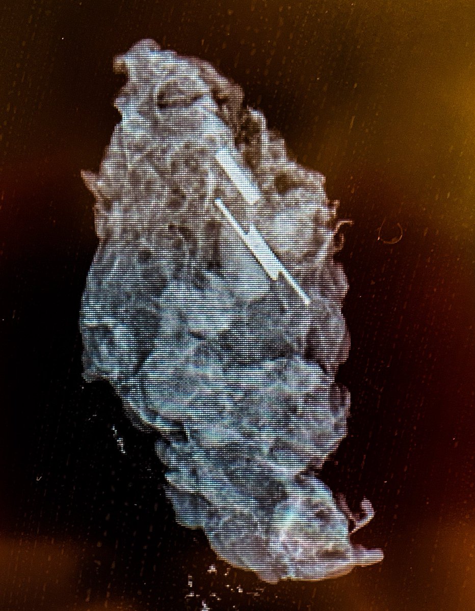 mdAlvaradoMD's tweet photo. #saviscout MEH. Rescued with a #magseed targeted sentinel node @endomag #breastcancer #neoadjuvant https://t.co/qETbtnTrli