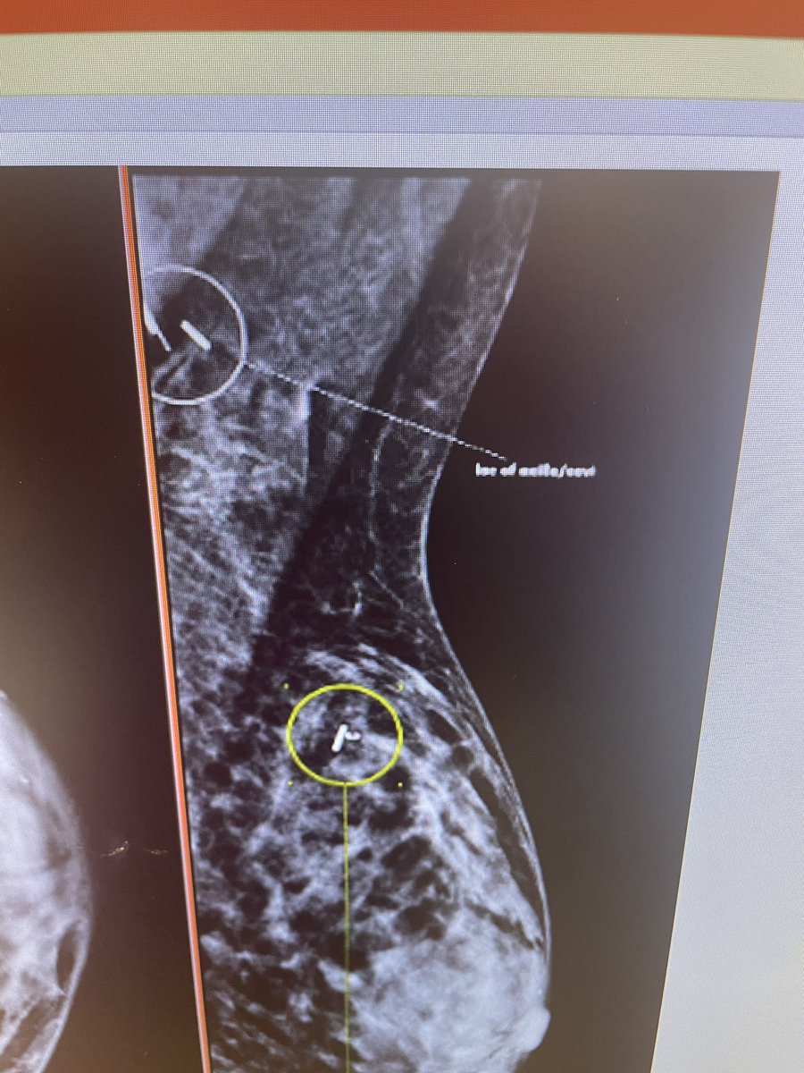 mdAlvaradoMD's tweet photo. This is why placing fragile electronics at the time of the biopsy shouldnโt be done. This patient had a #SAVIScout at the time of biopsy, referred to me for a second opinion and had to be rescued with a #Magseed @endomag #retirethewire #breastcancer #targetedaxillarysurgery https://t.co/L69TbFvsNV