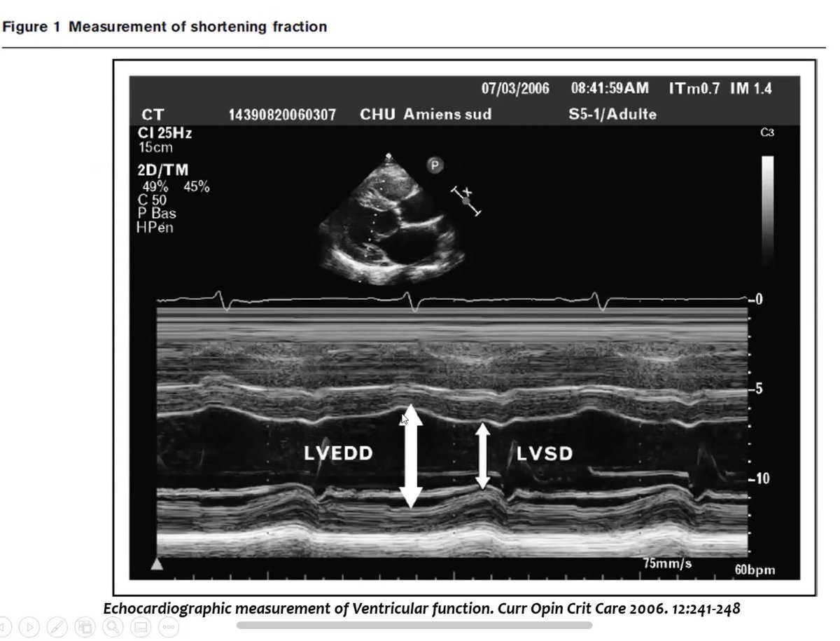 ItaloVasquezMD's tweet photo. #09DeMarzo2022 Dr Ángel Farro Fellow Ultrasonido de Emergencia. ONDAS - Función Sist. del Vent. Izq. https://t.co/dc9bMvAFEI vía @YouTube 
@ondasPOCUS @DreyfussAndrea @Dmartin07EM @JackelineEstof1 @AngelFarro1 @UPAndo6 @DavidReyesZAMNA @LazaroNury @JocorderoV @italo05airway https://t.co/U2pSjOsI9A
