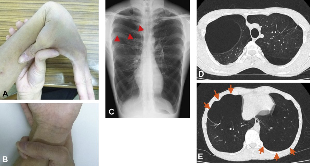 What is the diagnosis ?