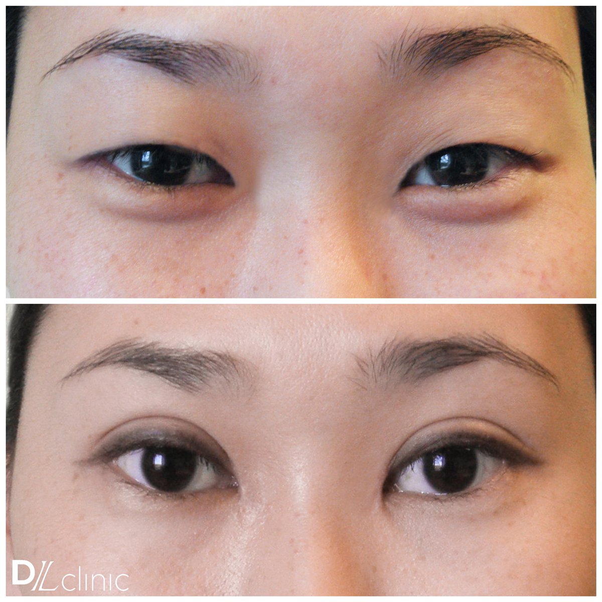 Новый взгляд: европеизация век
 
Современная пластическая хирургия способна творить чудеса. Так, если девушка с азиатским разрезом глаз мечтает сделать его более европейским, хирурги <a href="/DL_clinic/">Медицинский центр DLclinic</a> в силах ей помочь. 
#блефаропластика