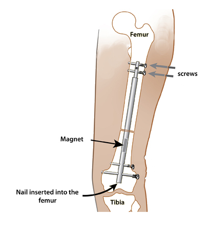 ColinJ_Keogh's tweet photo. 17/ I discuss partial bone replacement and full limb replacement, showing both options as viable with current technologies like intra-medullary devices or hum like robotic arms such as "Reachy"..... https://t.co/dzEZaG0diQ