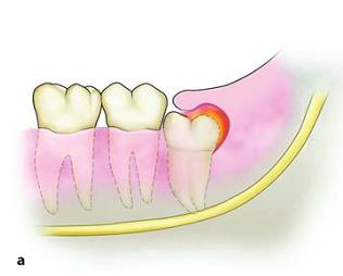 tregxel's tweet photo. Getting numerous text and calls and most of em are suffering from what is called "Pericoronitis "(infection of the tissues surrounding the crown)

For now, if you are in Lockdown, hospital wont consider this as an emergency, 
Home remedy, is keeping that area as clean as possible https://t.co/zCKqpzomsw