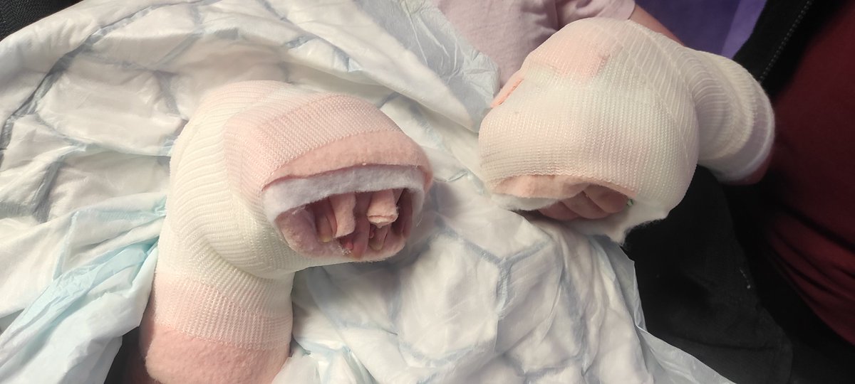 Thank you to plaster room for amazing job link with hand therapy team ..patients with severe spasticity treated after Botox and awesome achievement thank you Amanda ..you 🌟