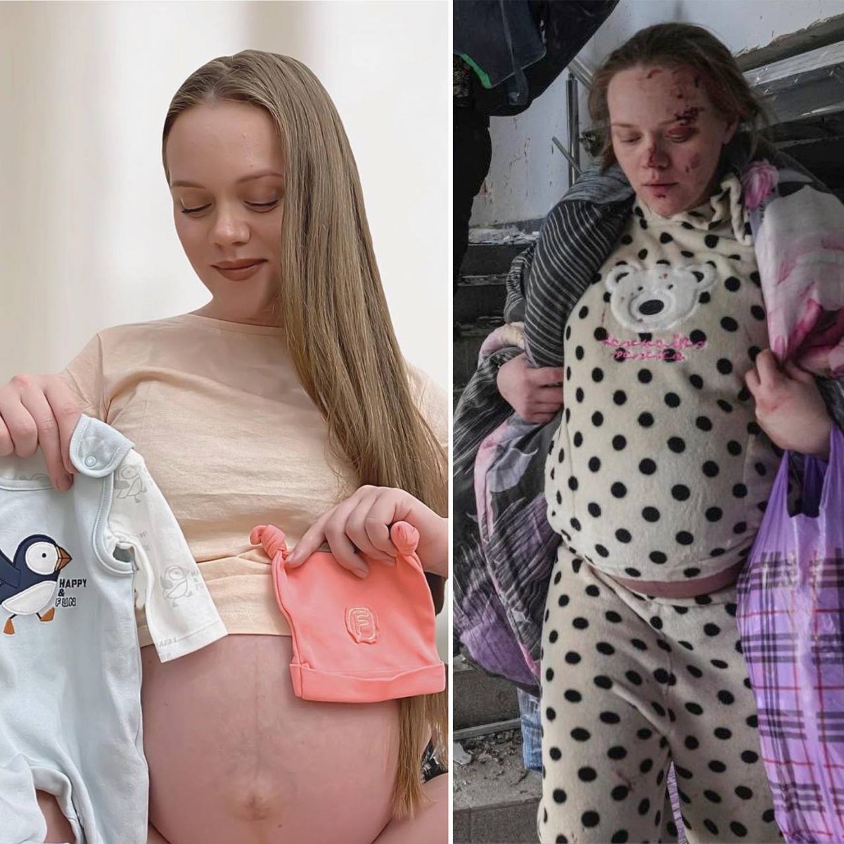A pregnant girl from the Mariupol maternity hospital, which was shelled yesterday by the Rashists.

On the left - before the invasion of Russian invaders. On the right is the result of "the Russian peace"
#Mariupol #MaternityHospital #StopRussia #ClosetheSkyoverUkraine #StopPutin