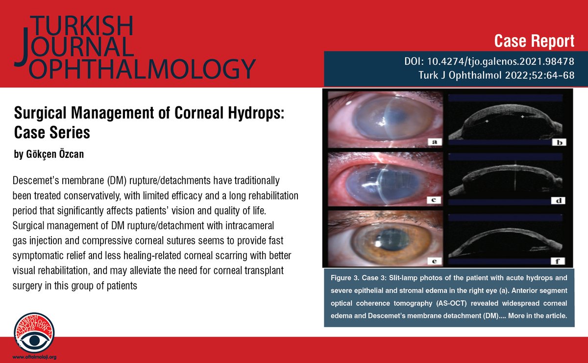 TurkJOphthalmol's tweet photo. Surgical Management of Corneal Hydrops: Case Series
You can see the free full text of the research by Gökçen Özcan et al.
Link : https://t.co/McxbmeztUc
#Descemets #membrane #detachment #rupture #acute #hydrops #Descemetopexy https://t.co/6XEHip6umE