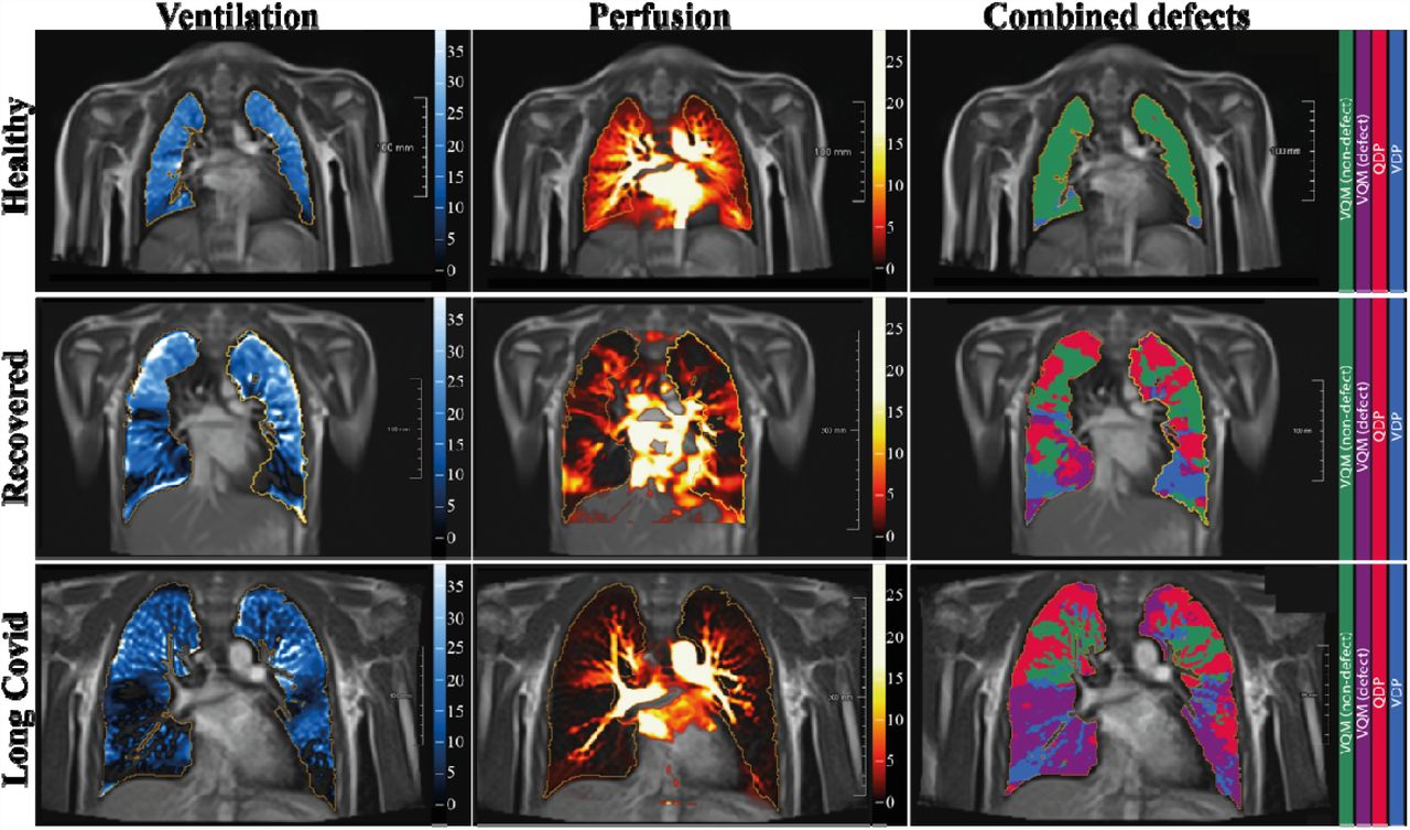 Dr. Jeff Gilchrist on Twitter to health controls, they found