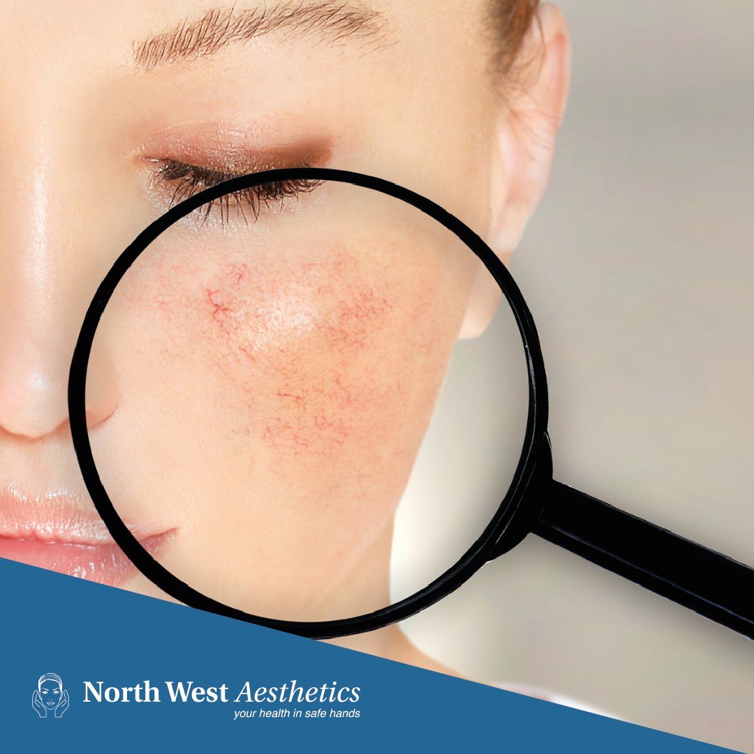 Rozatrol™ by <a href="/zoskinhealth/">ZO® Skin Health</a> provides effective relief from #rosacea symptoms. Reduce #ExcessOil, #redness and #inflammation with daily use. Book your skincare consultation at #NorthWestAesthetics.