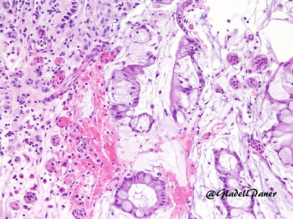 GladellPaner's tweet photo. Urethral biopsy in adult. Diagnosis? #GrayZonePath #GUPath
Answer in comment. https://t.co/nLeh53pM5e