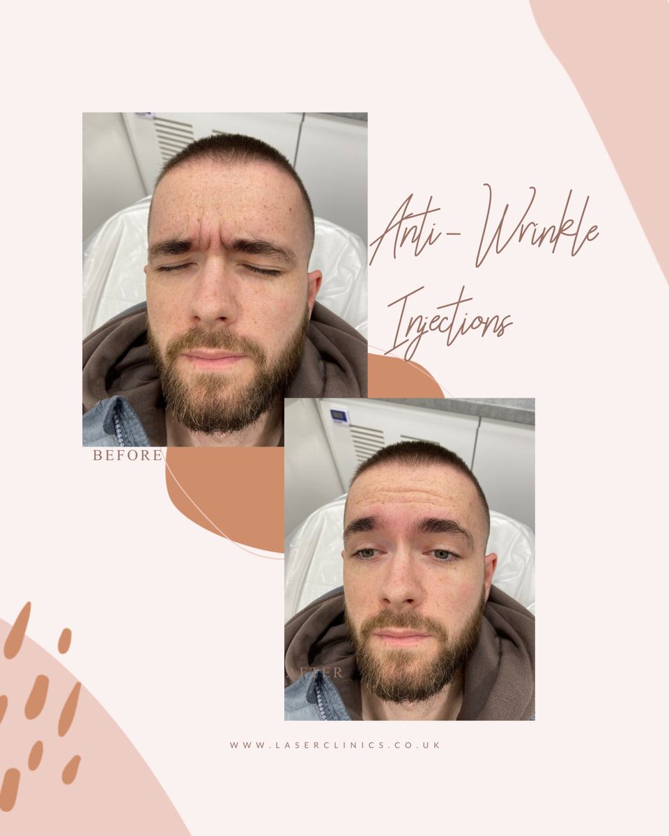 bewildered_by's tweet photo. Meet Luke 👋🏼

As you can see from his before photo, Luke had frown lines that he wanted to work on. We treated his frown lines with Anti-Wrinkle Injections and he is so happy with his results.

@laserclinicsuk_liverpool https://t.co/8TW8Ou283z