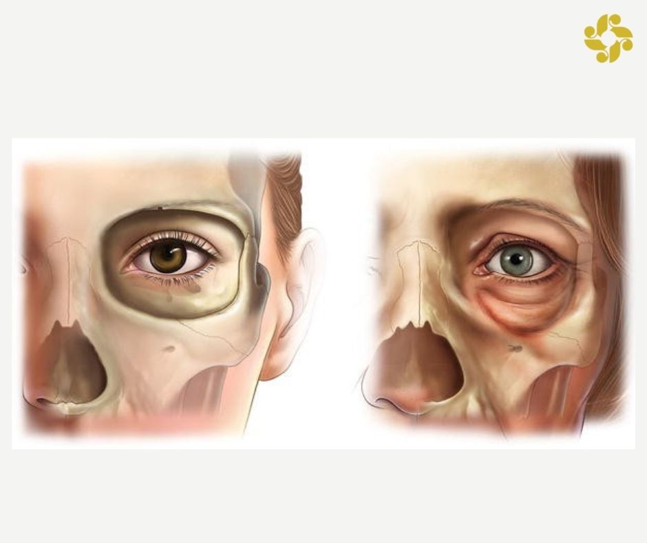 SkinBodyRenewal's tweet photo. There are two main factors that influence the skin ageing process. These are tissue atrophy and bone resorption. Think of a "sink" and "sag" effect that appears over time https://t.co/vbhSo0qaaC #SkinRenewalSA #SaggingFace #skin #ageing #volumeloss #boneloss #antiageing https://t.co/54wJ0i68p9