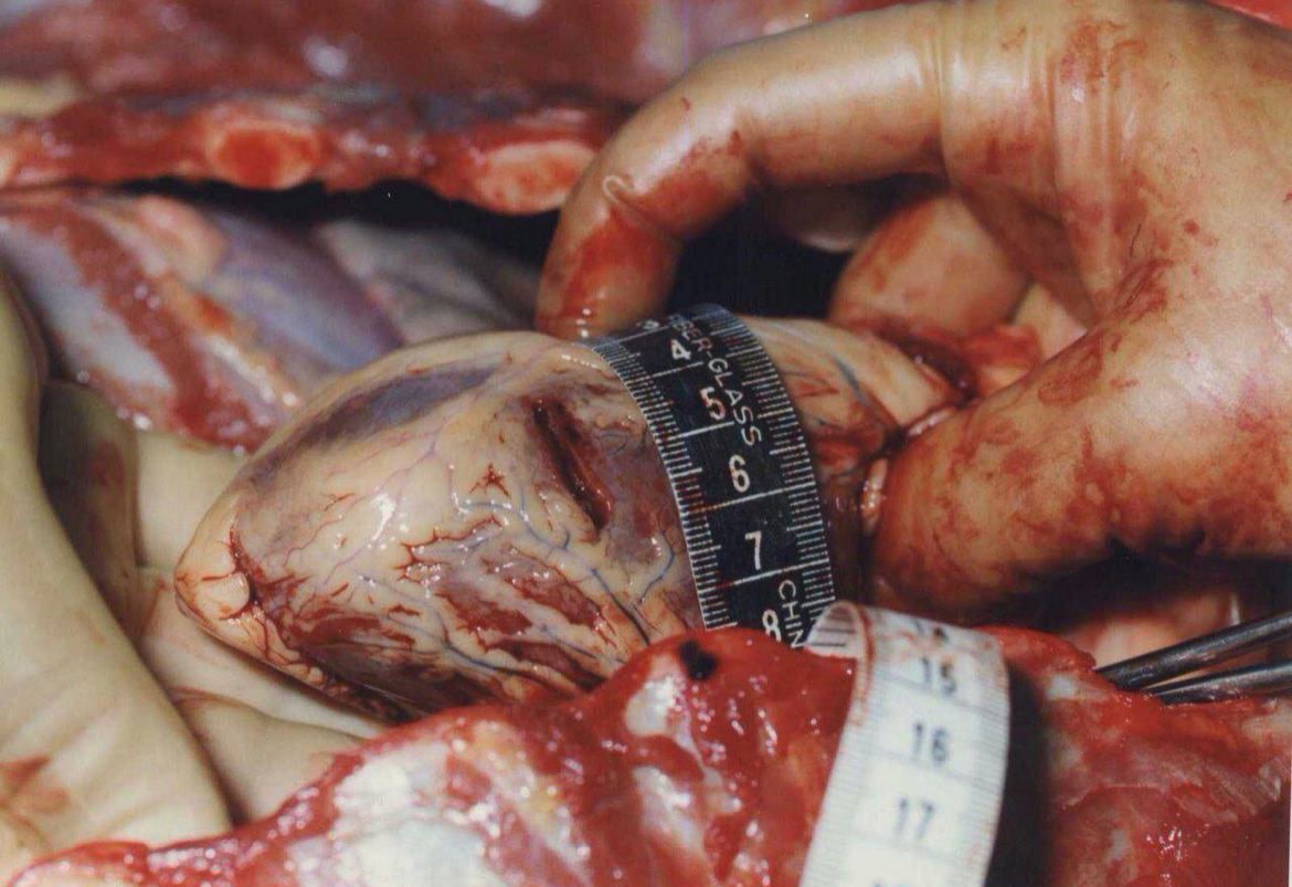 forensicmedic02's tweet photo. The consequences of a knife wound right in the heart. Последствия ножевого ранения прямо в сердце. https://t.co/P8V997szMX