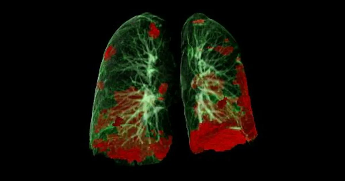 AuntMinnie's tweet photo. Of all the medical imaging modalities, perhaps none has demonstrated its value for diagnosing patients with COVID-19 more than CT. But how exactly should CT be used in clinical practice? #ECROverture #radiology https://t.co/sBbaMJKNfH https://t.co/cVeBfZnd5g