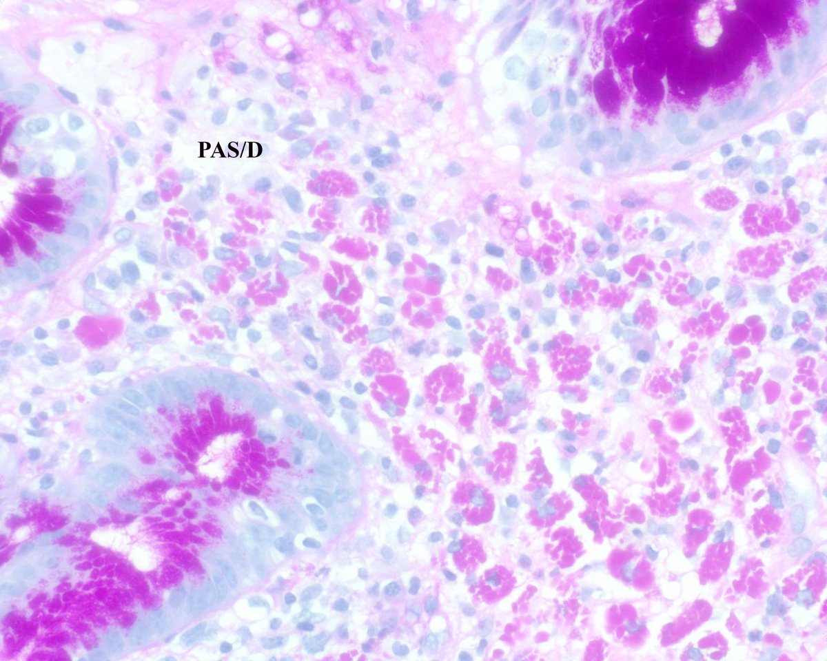 An amazing example of Russell body gastritis.  This one was associated with H. pylori (the case about half the time). innovativesciencepress.com