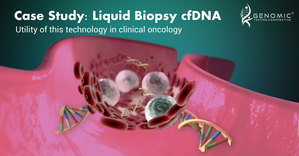 GenomicTesting's tweet photo. Check out this interesting cases study utilizing GTC's liquid biopsy technology. The use of our molecular karyotype helped nail this case.

Read the case study here (See case study tab):
https://t.co/ifhLmHr6sV

#GTC #GenomicTestingCooperative #LiquidBiopsy #cfDNA https://t.co/wS86OCNBJT