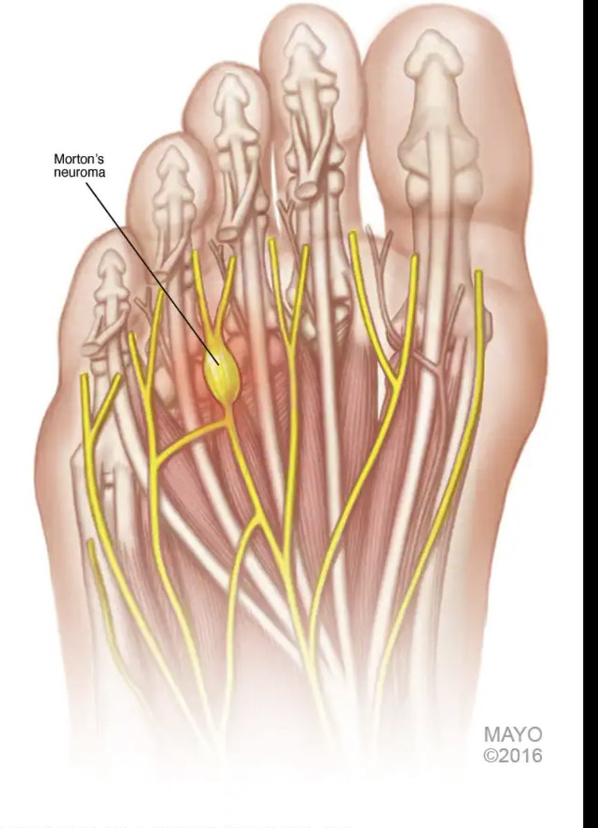 1) A 🧵 looking at Morton’s Neuroma (MN). 

MN is considered an entrapment degenerative neuropathy affecting the interdigital nerve as it lies beneath the intermetatarsal ligament.